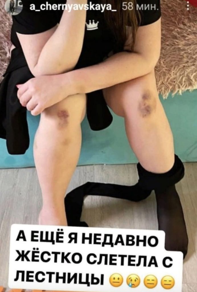 Сашу Черно с жуткими синяками нашли после гулянки